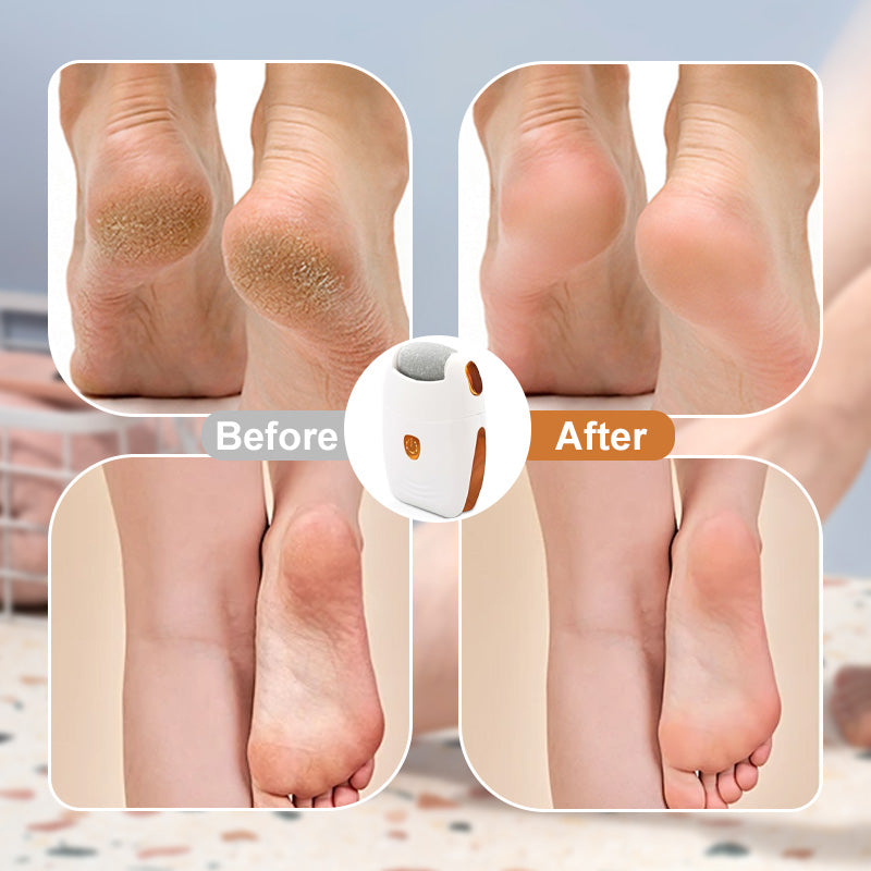 Automatic Callus Remover for Feet